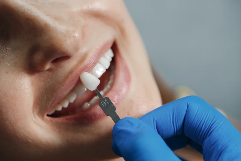 Tratamento de facetas dentárias na Bella Clinic